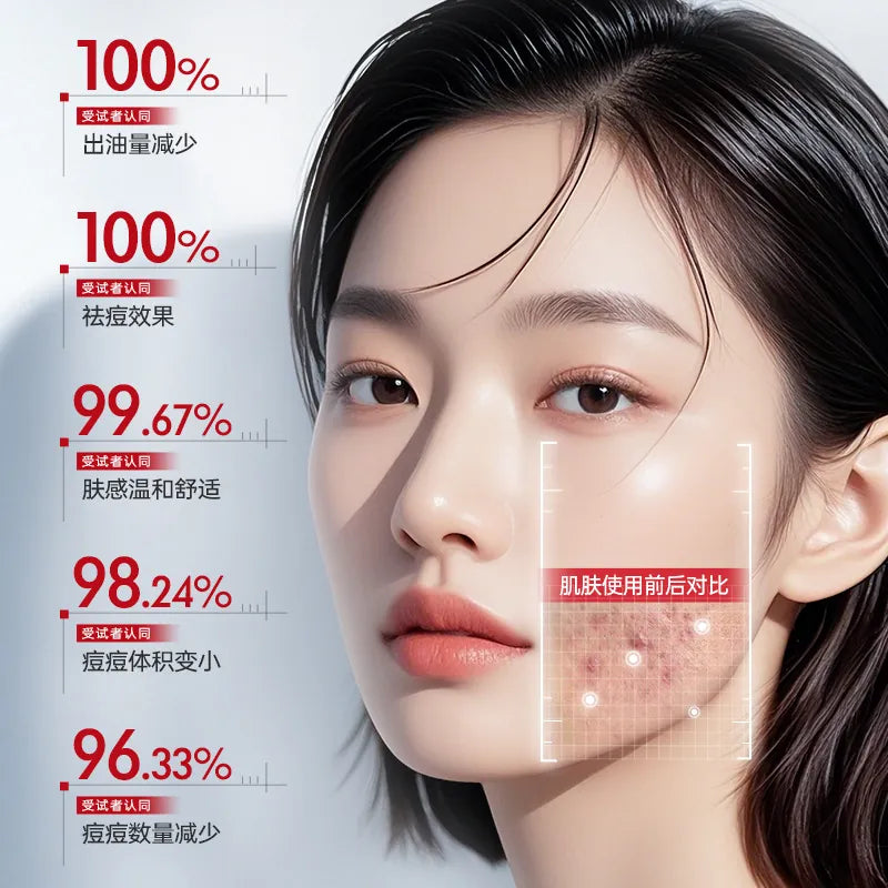 Agulia Salicylic Oil Control Anti-acne Cream